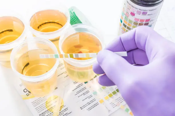 The Science Behind Alcohol Urine Tests and Their Effectiveness in Baton Rouge, LA The Science Behind Alcohol Urine Tests and Their Effectiveness in Baton Rouge, LA